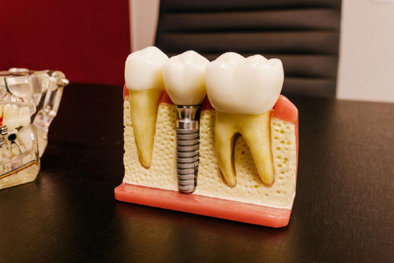 Dental Implants Hillsboro Oregon