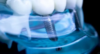 Expert Advice: Should I Brush My Teeth Before Going To The Dentist?
