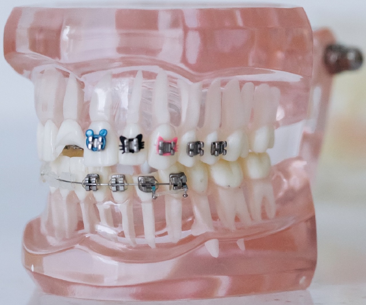 What Do Teeth Look Like Under Veneers